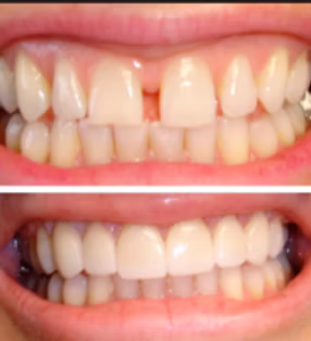 Dental Bridges