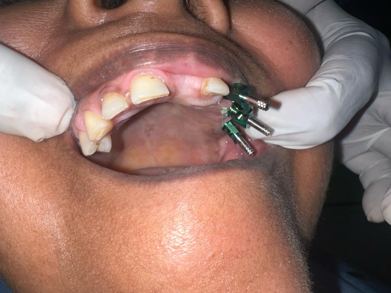 Dental Bridges
